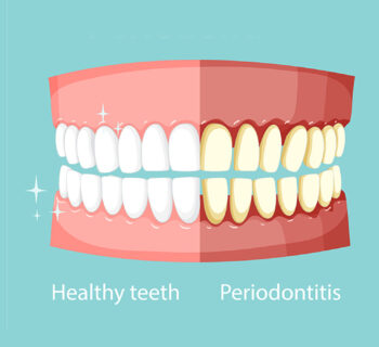 The Importance of Gum Disease Prevention: How Regular Care Can Keep Your Gums Healthy