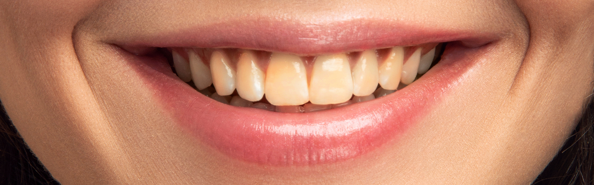 What Causes Yellow Spots on Teeth?