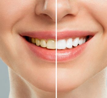 Healthy Smiles in Highlands Mountain Park Ranch: The Best Place for Teeth Whitening Treatment Near You