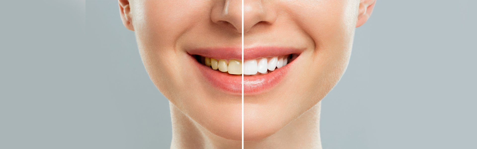 Healthy Smiles in Highlands Mountain Park Ranch: The Best Place for Teeth Whitening Treatment Near You